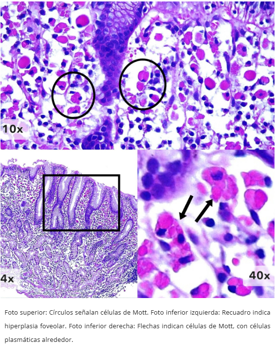 Gastritis de Células Plasmáticas