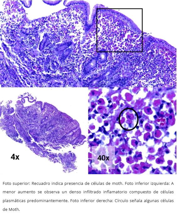Gastritis de Células Plasmáticas