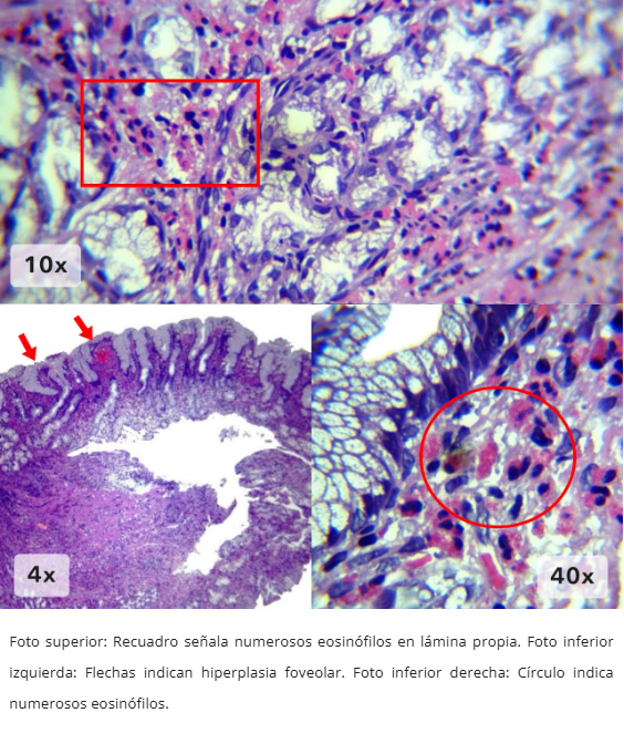 Gastritis Eosinofílica