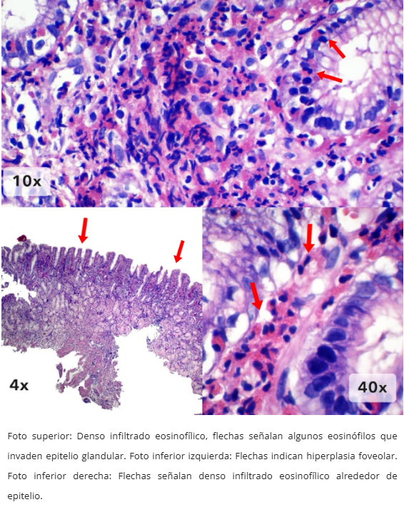 Gastritis Eosinofílica