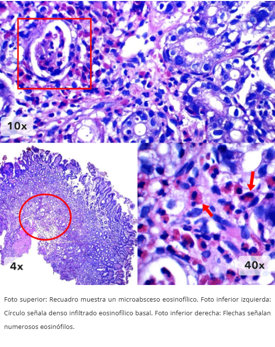 Gastritis Eosinofílica