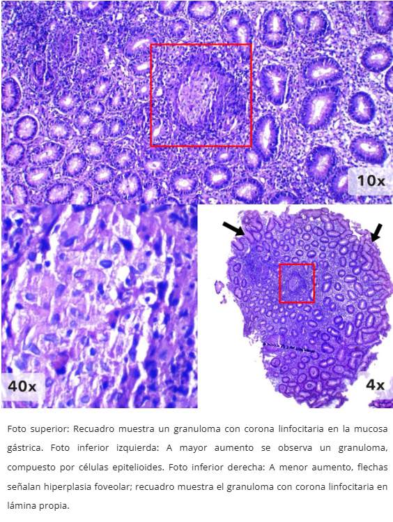 Gastritis Granulomatosa