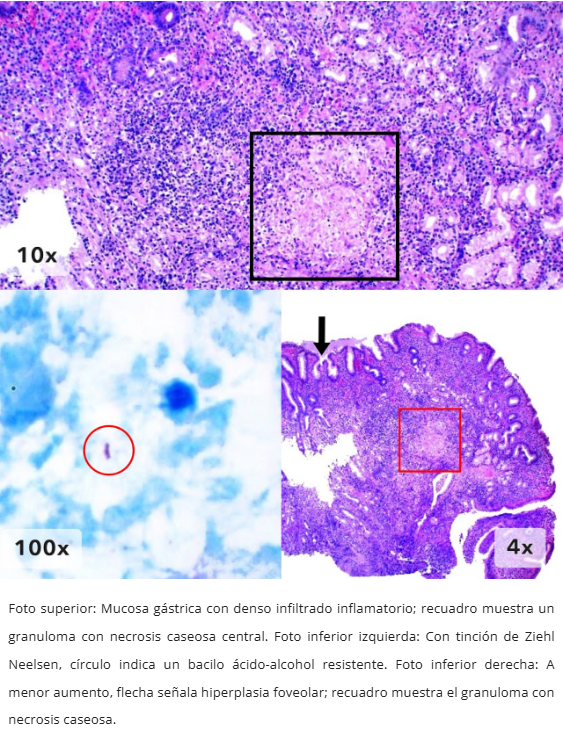 Gastritis Granulomatosa
