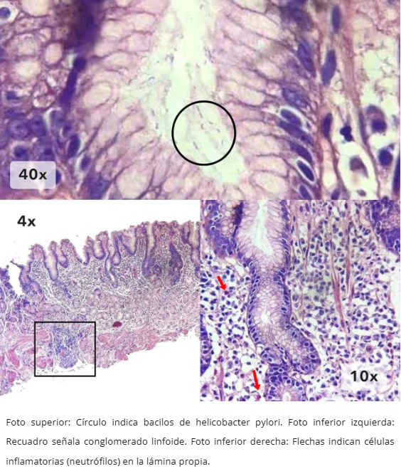 Microscopía de gastritis por H. pylori