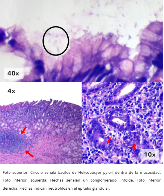 Gastritis por H. pylori