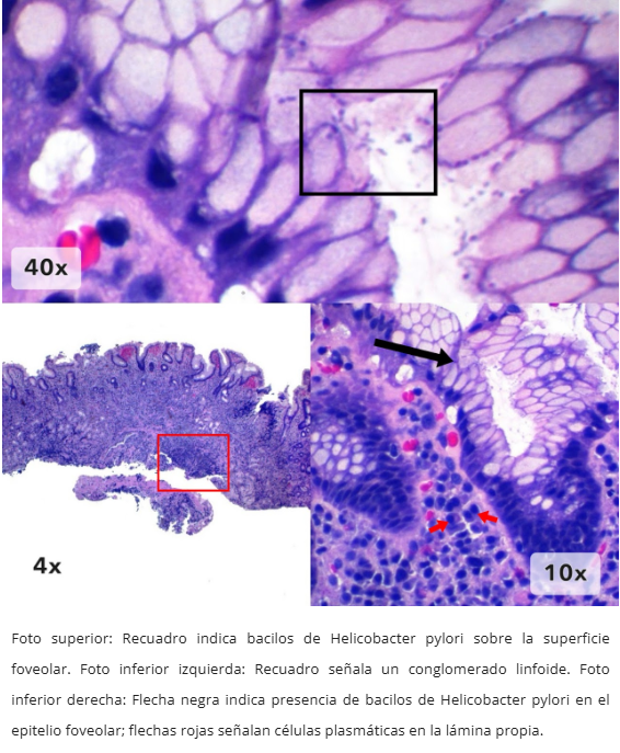 Gastritis por H. pylori