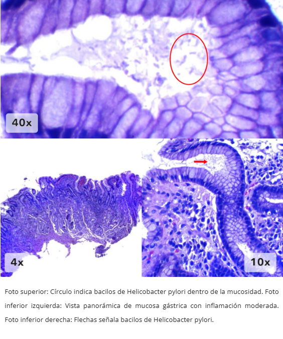 Gastritis por H. pylori