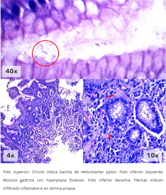 Gastritis por H. pylori