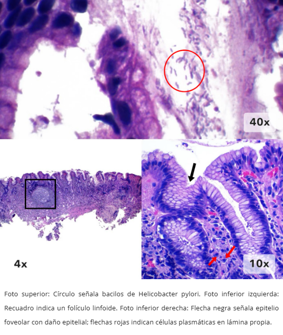 Gastritis por H. pylori