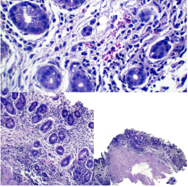 Gastritis Autoinmune