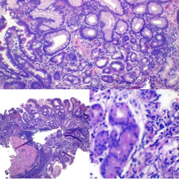 Gastritis Autoinmune