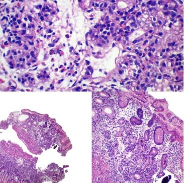 Gastritis Autoinmune