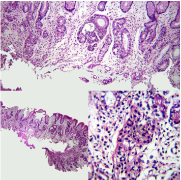 Gastritis Autoinmune