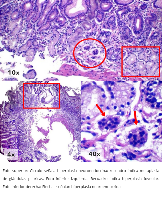 Gastritis Autoinmune