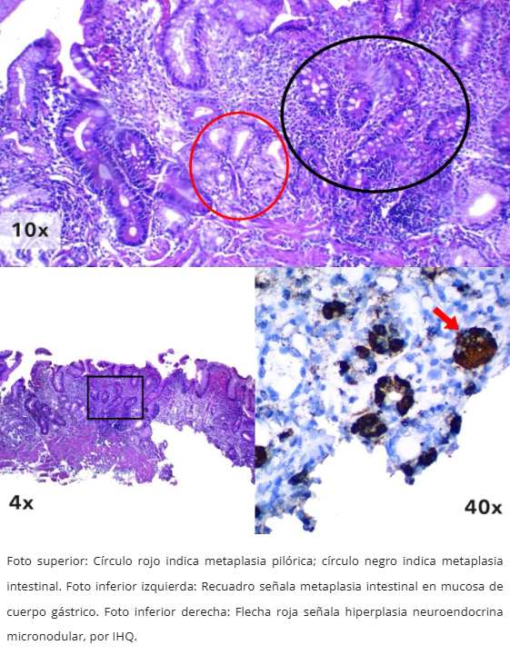 Gastritis Autoinmune