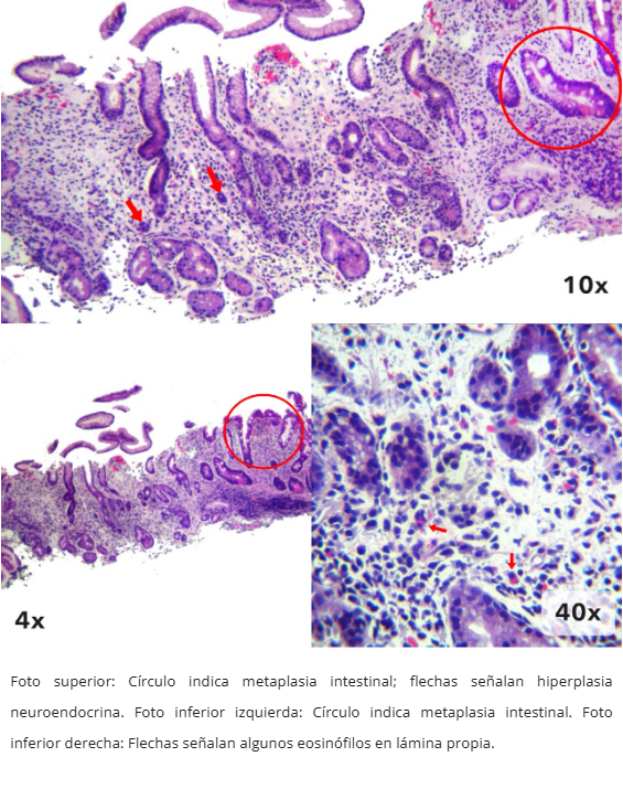 Gastritis Autoinmune