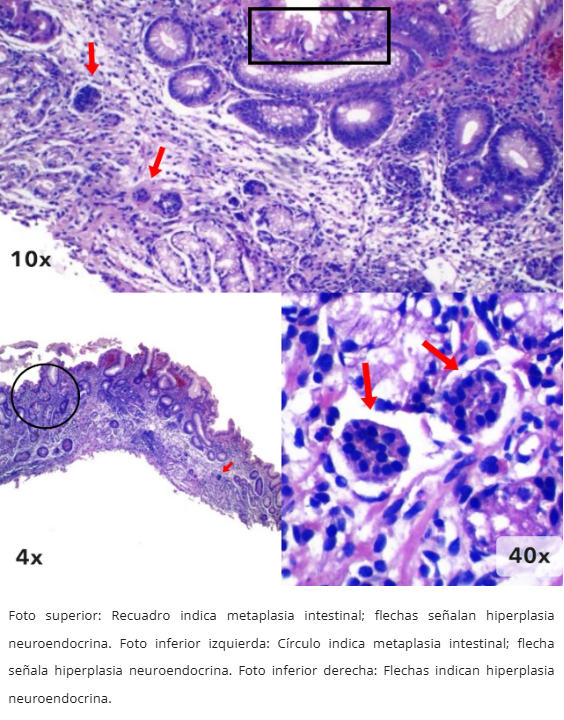 Gastritis Autoinmune