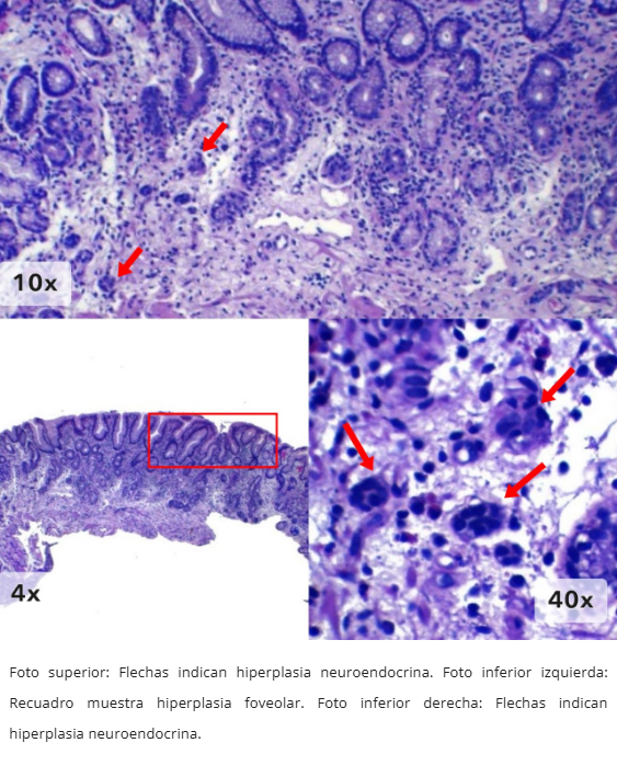 Gastritis Autoinmune