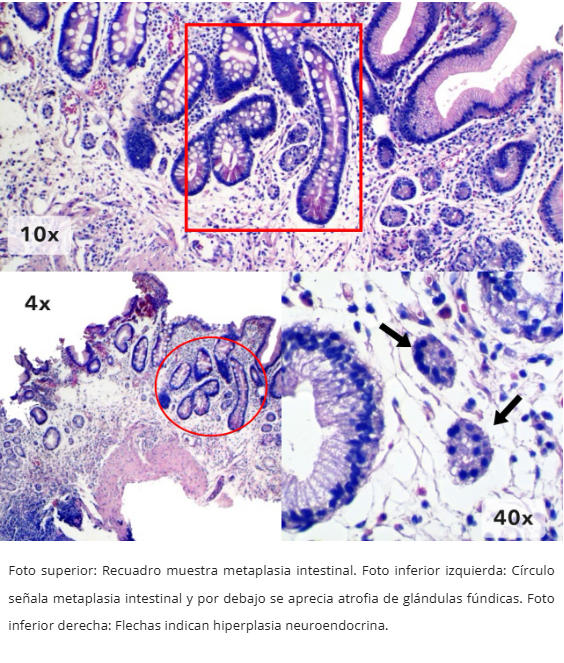 Gastritis Autoinmune