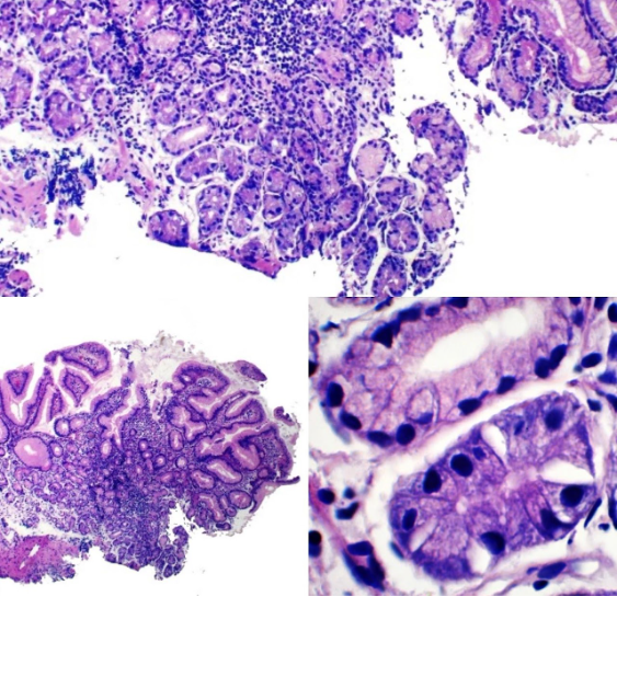 Gastritis Autoinmune