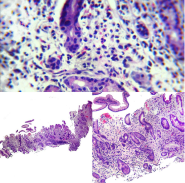 Gastritis Autoinmune