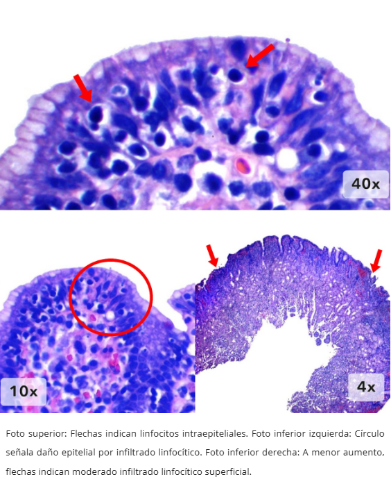 Microscopía de gastritis linfocítica