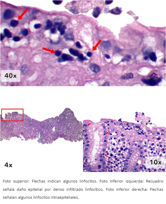 Gastritis Linfocítica