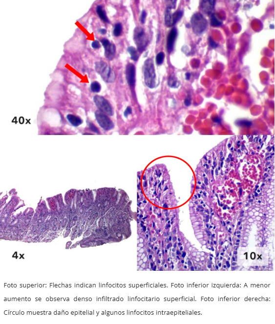 Gastritis Linfocítica