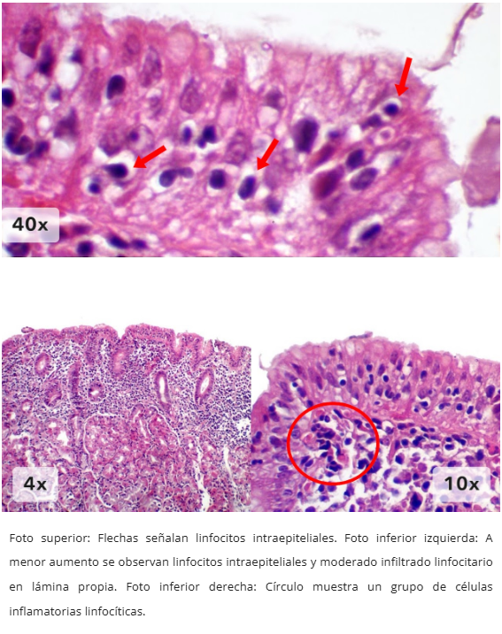 Gastritis Linfocítica