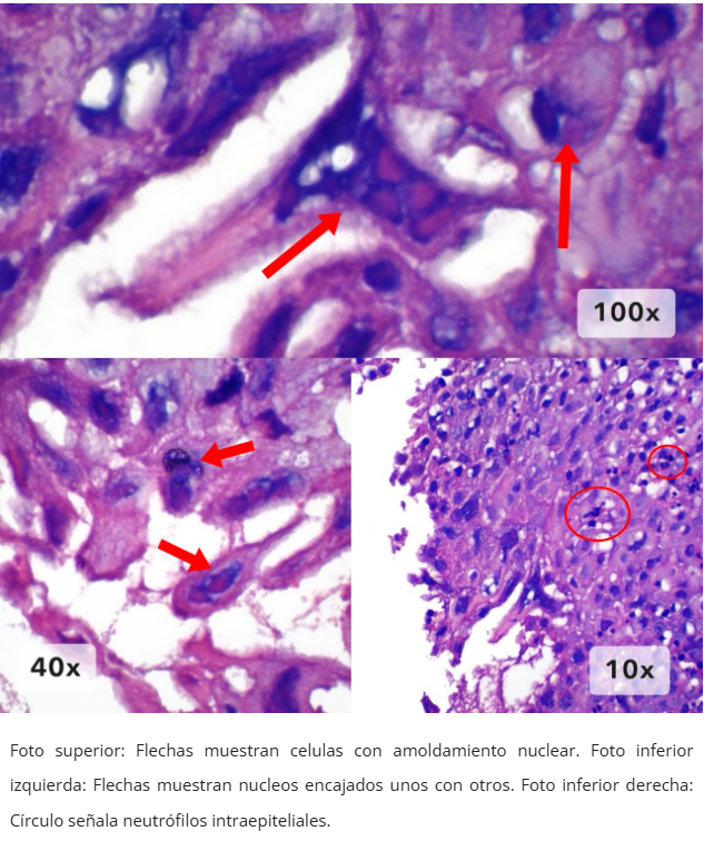 Esofagitis herpética