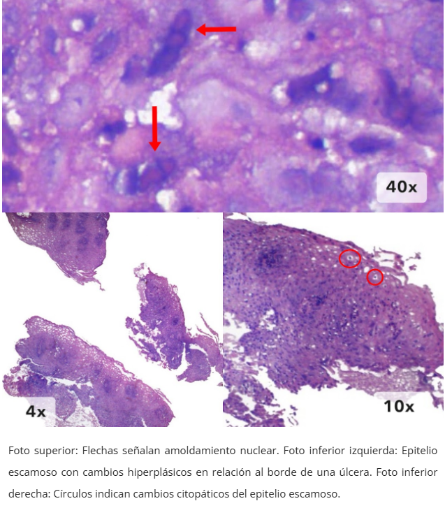 Esofagitis herpética
