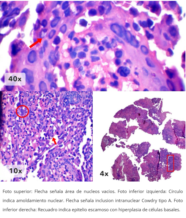 Esofagitis herpética