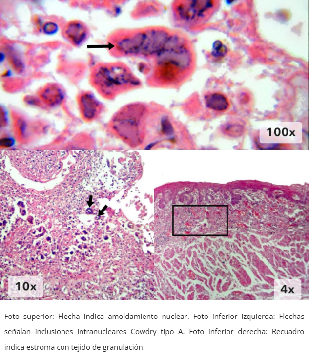 Esofagitis herpética