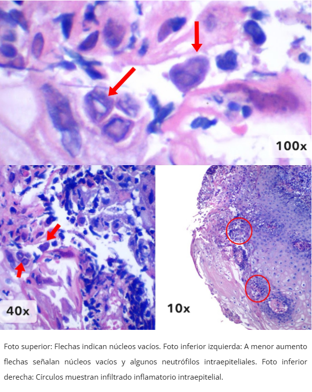 Esofagitis herpética
