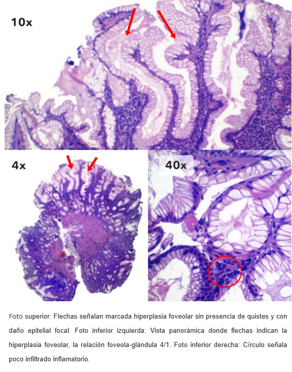 Hiperplasia Foveolar Polipoide