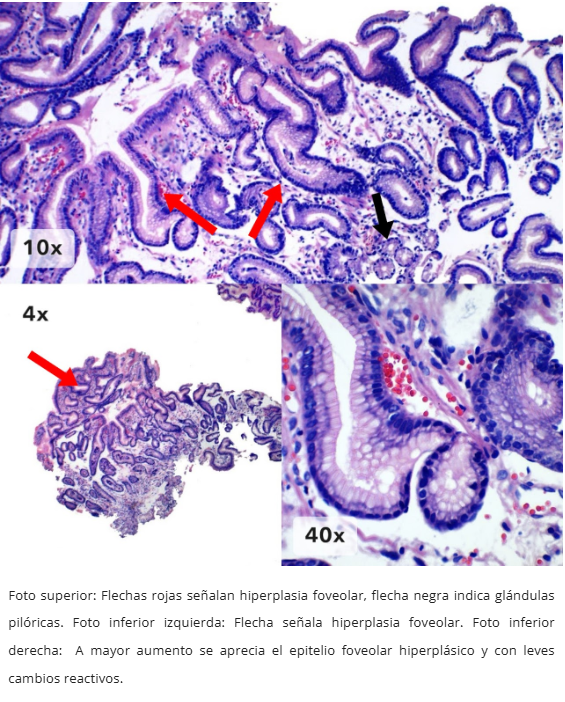 Hiperplasia Foveolar Polipoide