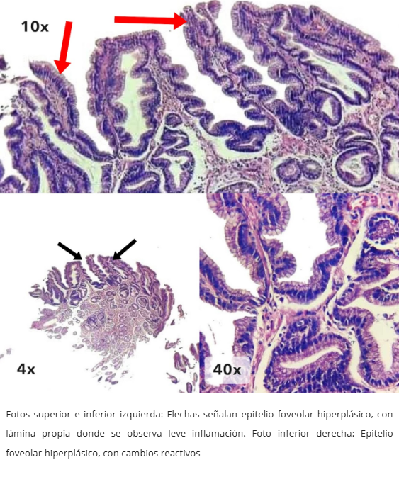 Hiperplasia Foveolar Polipoide