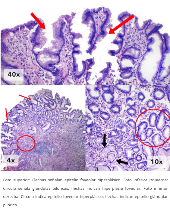Hiperplasia Foveolar Polipoide