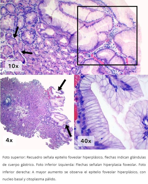 Hiperplasia Foveolar Polipoide