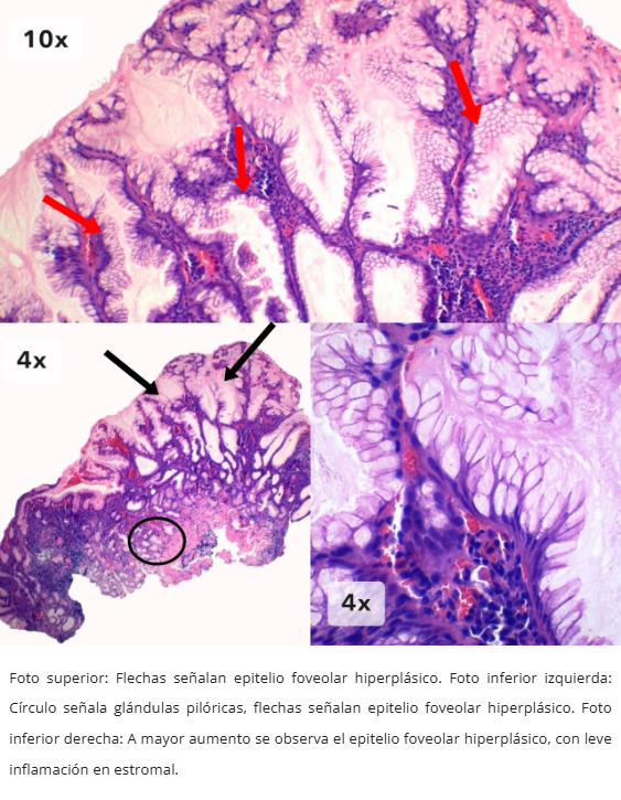 Hiperplasia Foveolar Polipoide