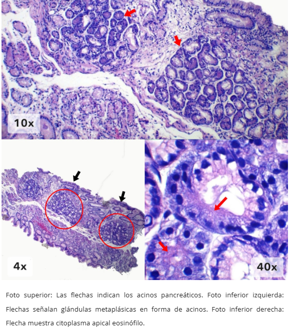 Metaplasia Acinar Pancreática