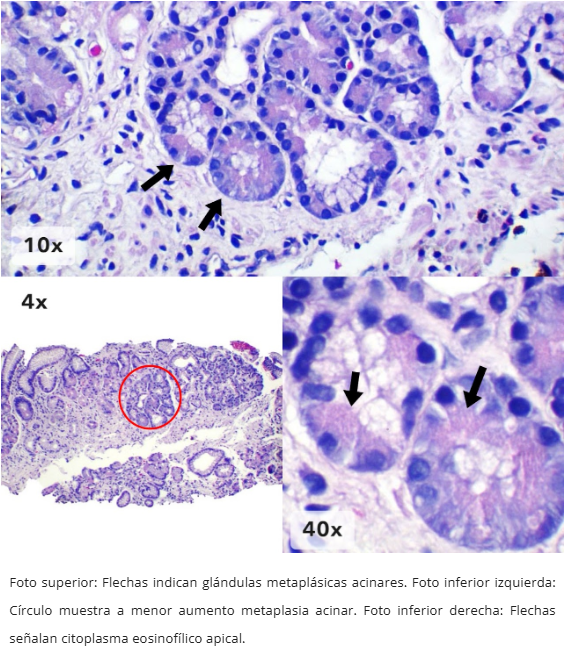 Metaplasia Acinar Pancreática
