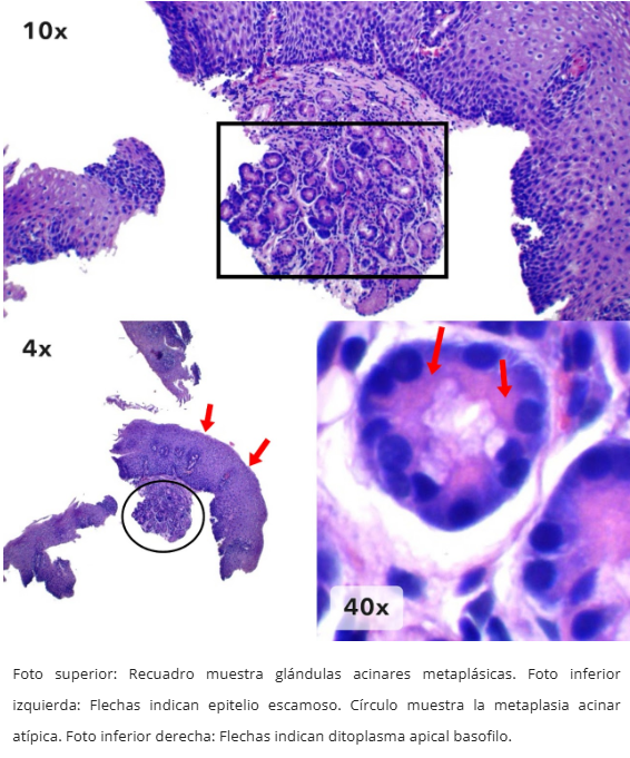 Metaplasia Acinar Pancreática