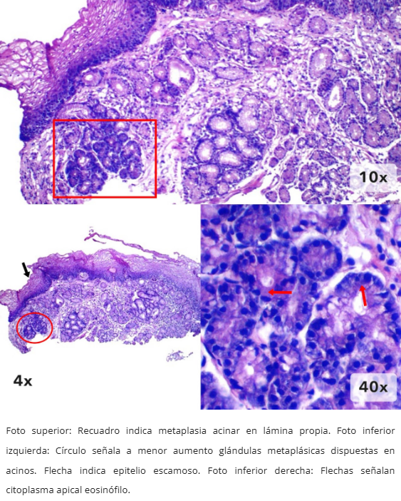 Metaplasia Acinar Pancreática