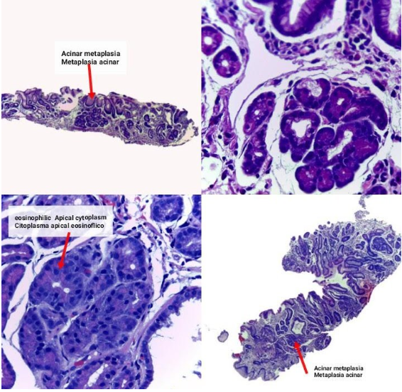 Metaplasia Acinar Pancreática