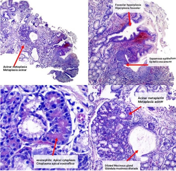 Metaplasia Acinar Pancreática