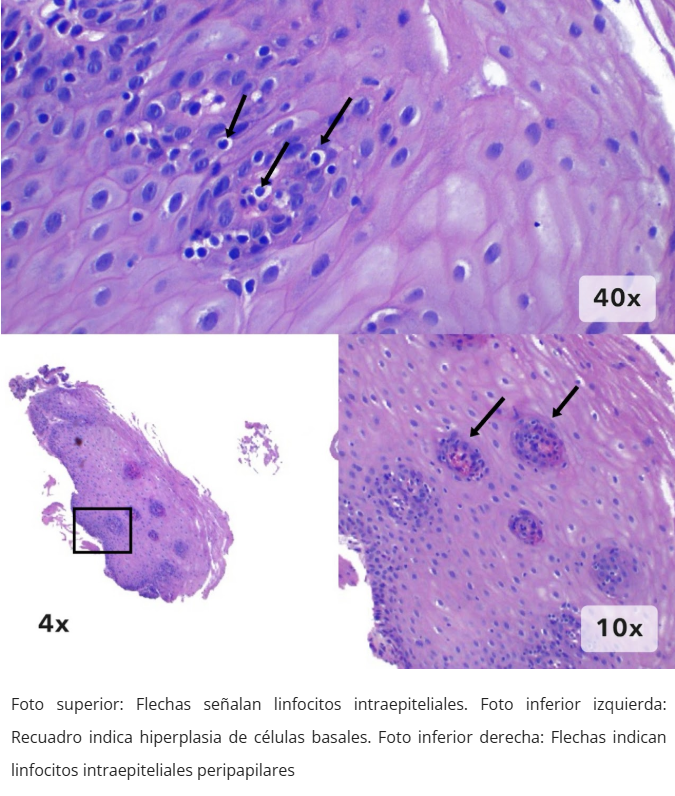 Esofagitis linfocítica - Hiperplasia y linfocitos intraepiteliales