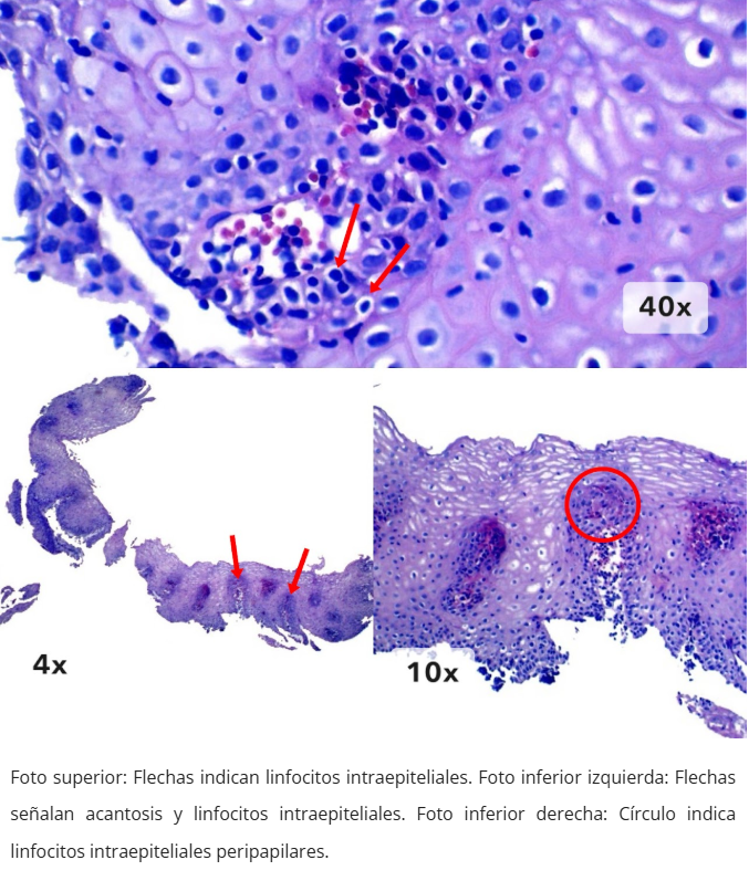 Esofagitis linfocítica - Linfocitos peripapilares