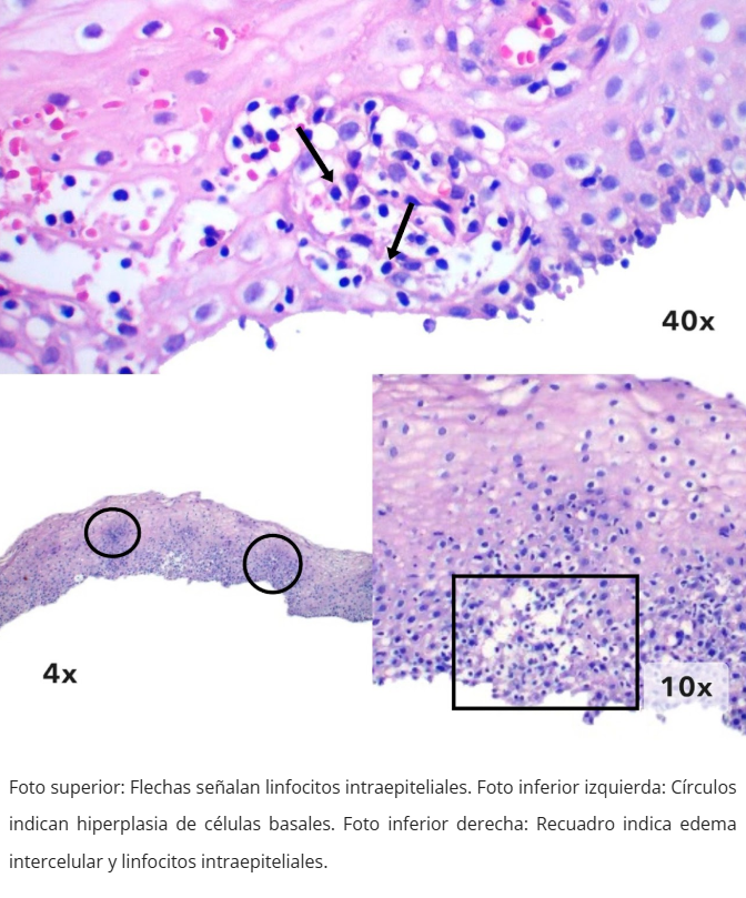 Esofagitis linfocítica - Edema intercelular