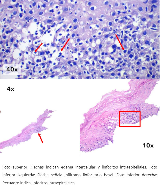 Esofagitis linfocítica - Disqueratosis